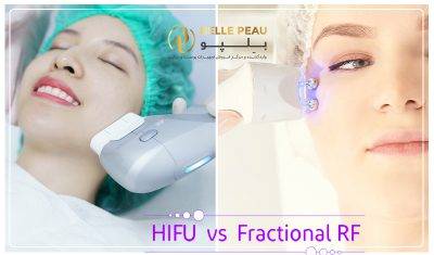 1661764365 HIFU vs Fractional RF Skin Tightening 1 400x235 - نوشته ها و مقالات