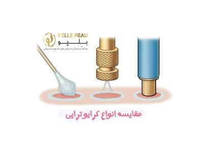 مقایسه انواع کرایو