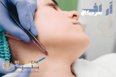 دستگاه آراف سرجیکال چیست
